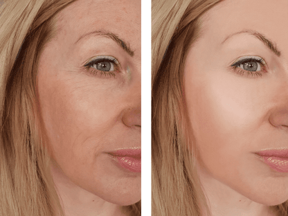 Get Botox-Level Tightening Without the Needle, Stroke Face, or 800 Maintenance!