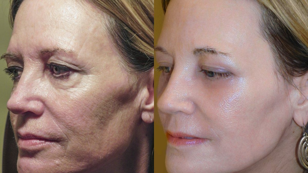 Get Botox-Level Tightening Without the Needle, Stroke Face, or 800 Maintenance!