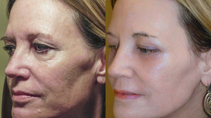 Get Botox-Level Tightening Without the Needle, Stroke Face, or 800 Maintenance!