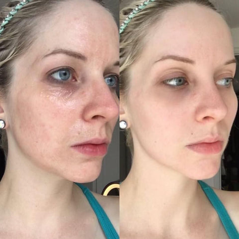 Get Botox-Level Tightening Without the Needle, Stroke Face, or 800 Maintenance!