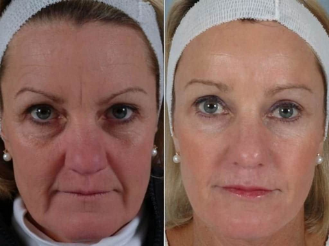 Get Botox-Level Tightening Without the Needle, Stroke Face, or 800 Maintenance!